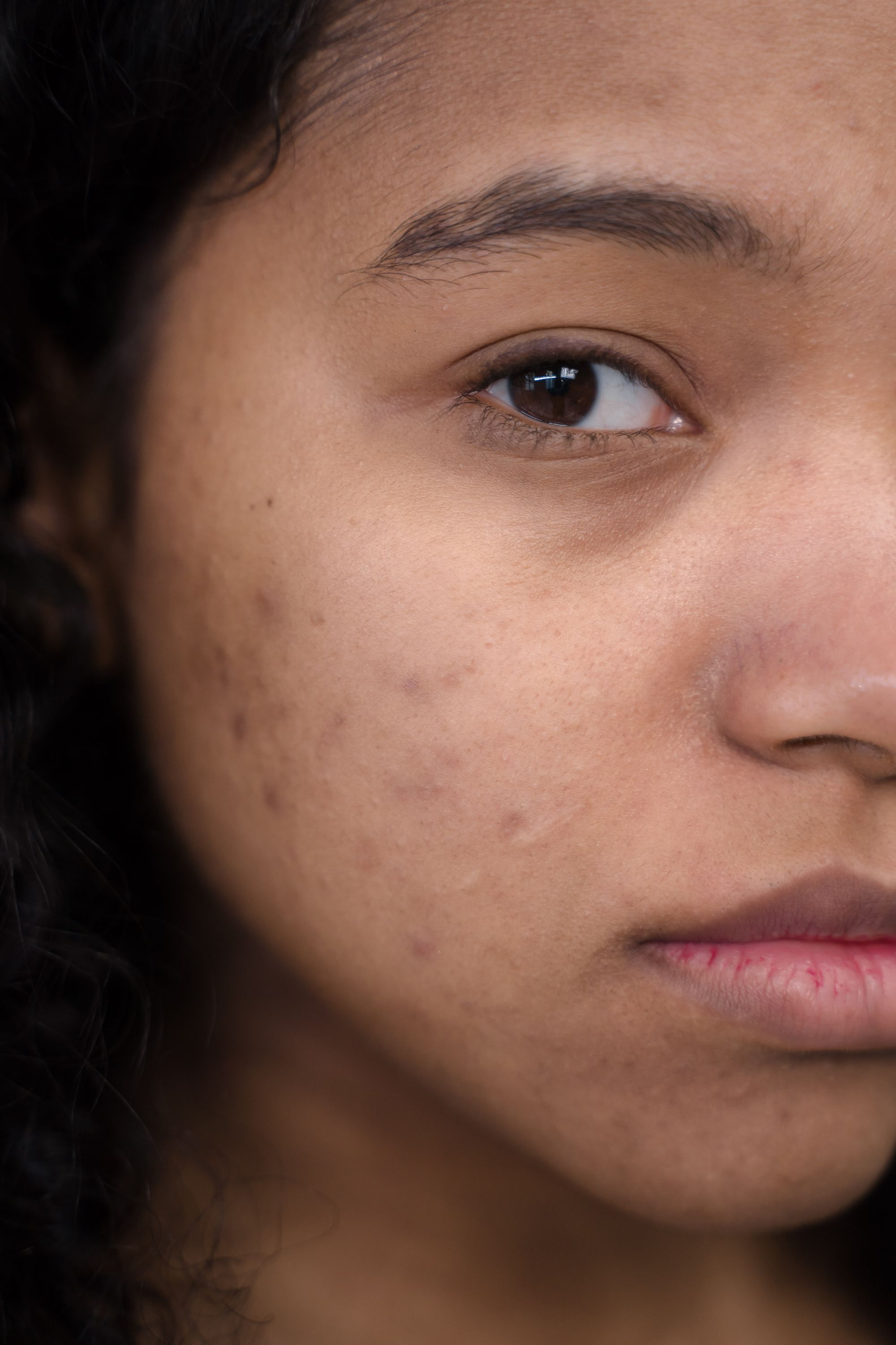Close-up of a cheek with acne and acne marks