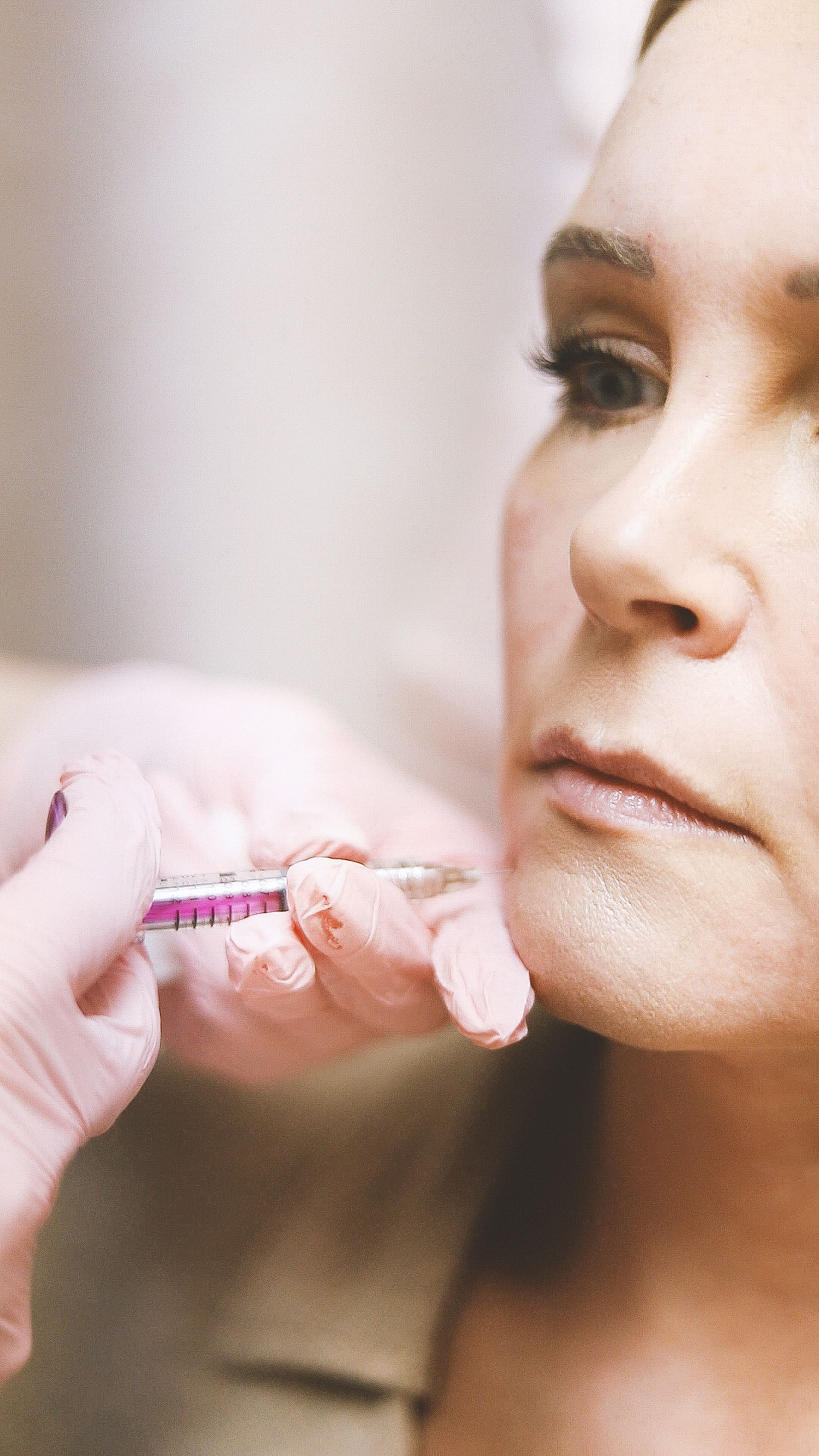 Close-up of a filler injection along the lower face