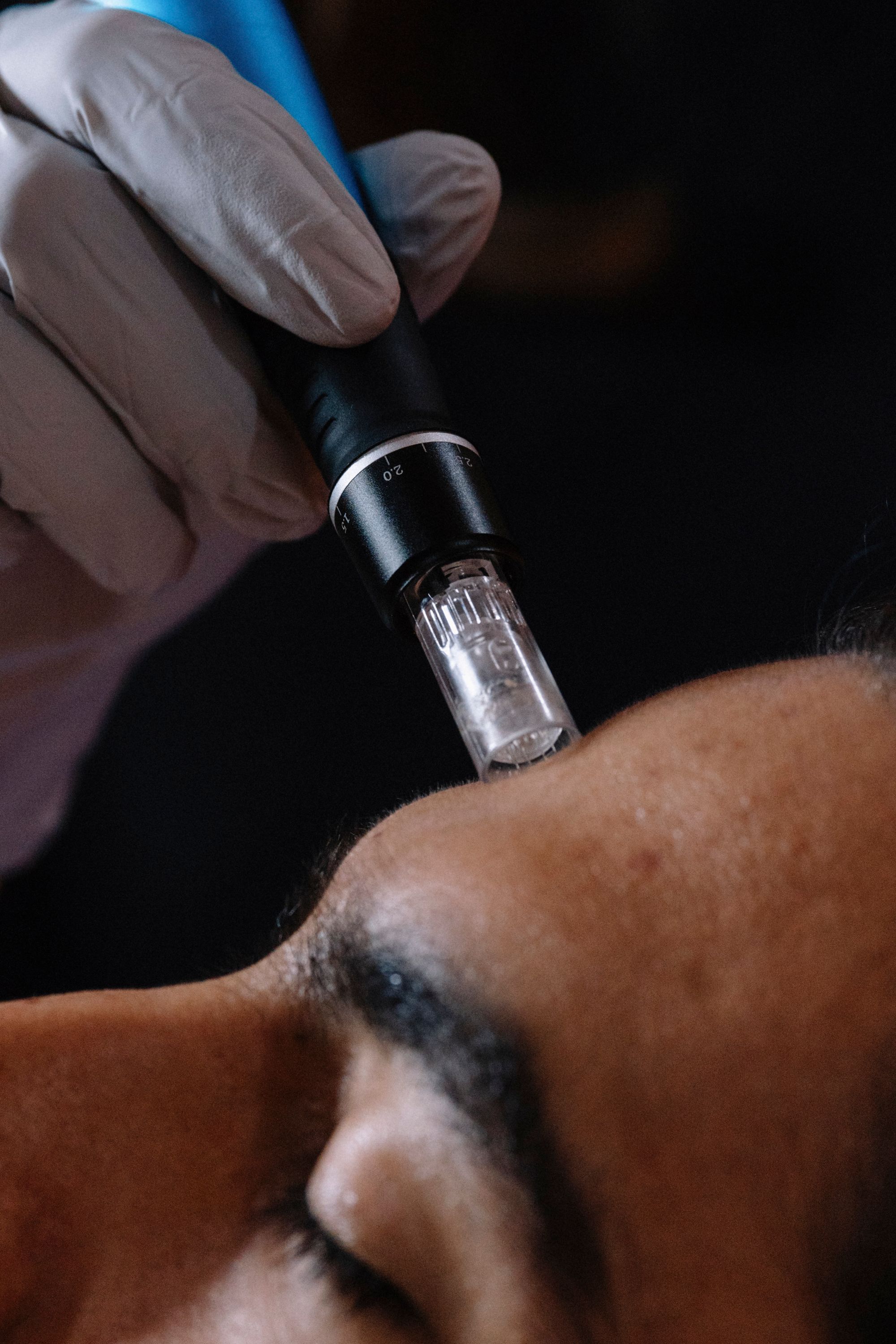 A microneedling pen on a patient's forehead, dark background