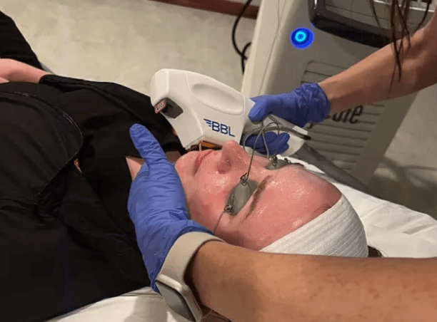 A BBL treatment at the practice, the handpiece on a patient in protective eyewear